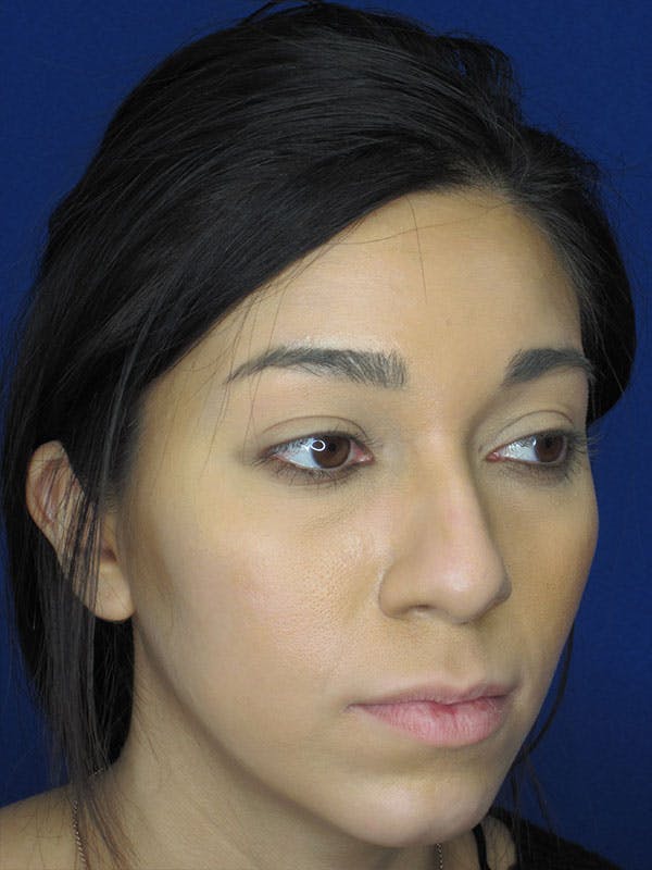 Rhinoplasty Before & After Gallery - Patient 92118122 - Image 3