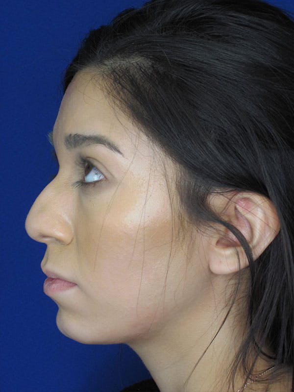 Rhinoplasty Before & After Gallery - Patient 92118122 - Image 5