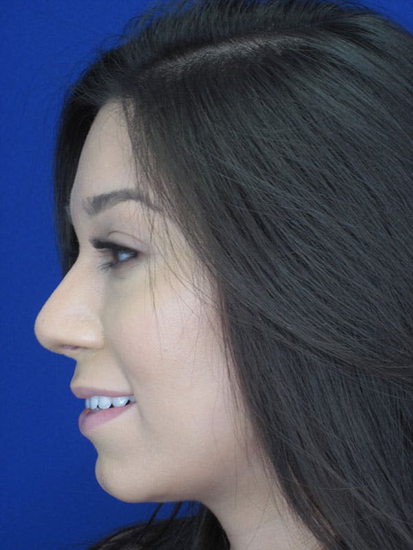 Rhinoplasty Before & After Gallery - Patient 92118122 - Image 6