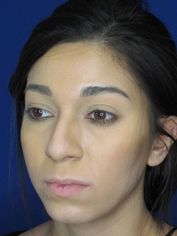 Rhinoplasty Before & After Gallery - Patient 92118122 - Image 7