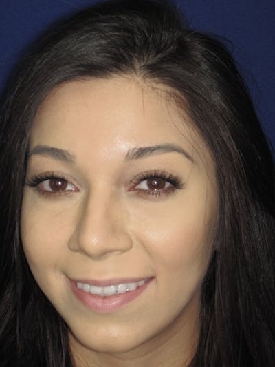 Rhinoplasty Before & After Gallery - Patient 92118122 - Image 8