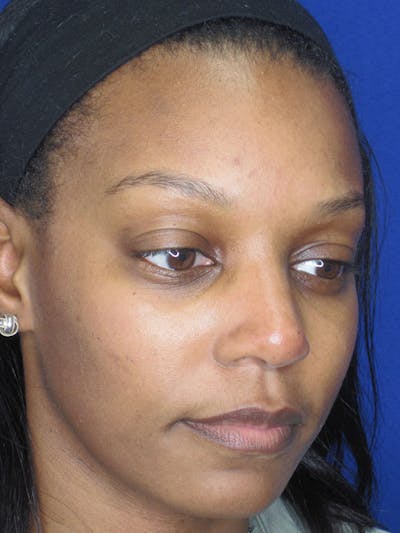 Rhinoplasty Before & After Gallery - Patient 92118133 - Image 4
