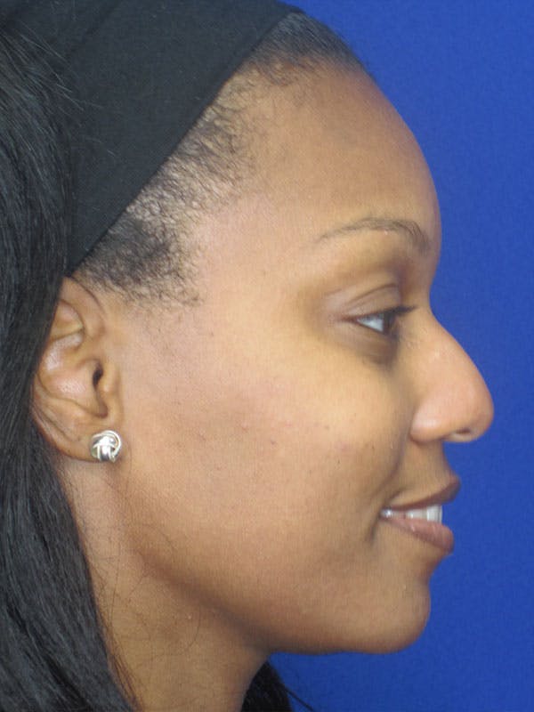 Rhinoplasty Before & After Gallery - Patient 92118133 - Image 5