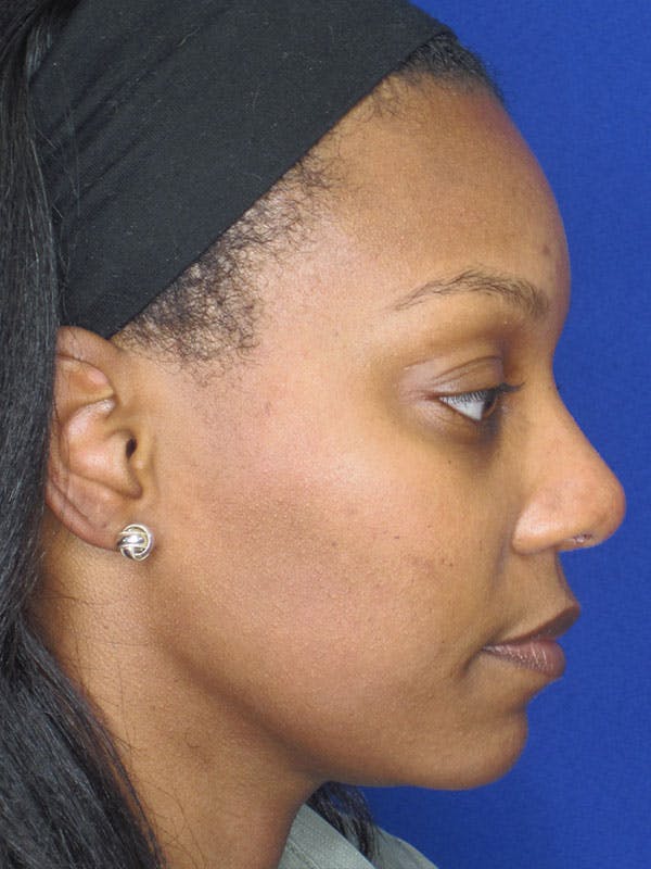 Rhinoplasty Before & After Gallery - Patient 92118133 - Image 6