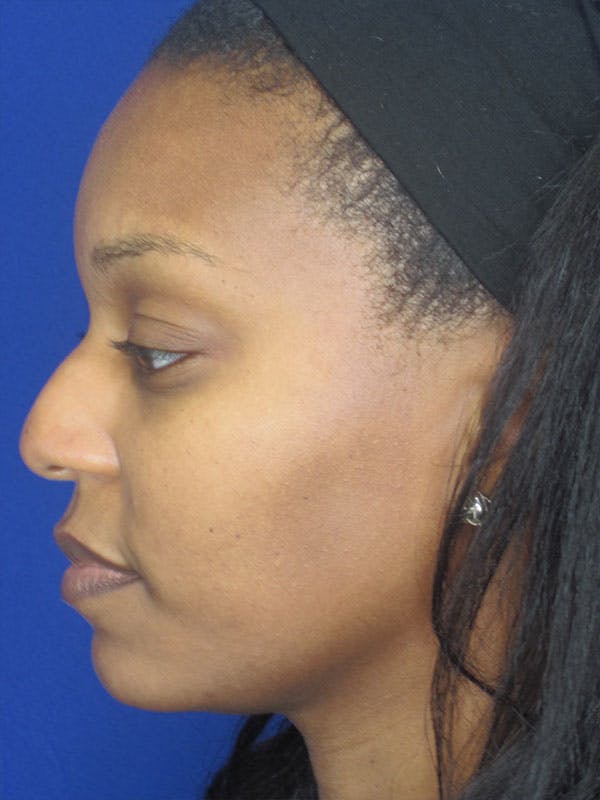 Rhinoplasty Before & After Gallery - Patient 92118133 - Image 7