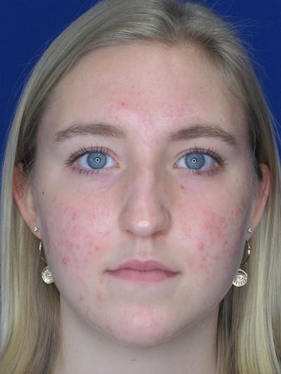 Rhinoplasty Before & After Gallery - Patient 92118134 - Image 1