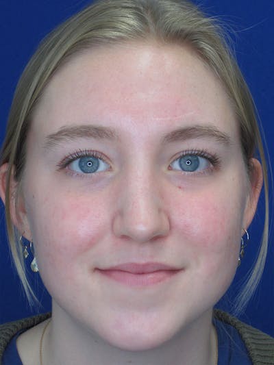 Rhinoplasty Before & After Gallery - Patient 92118134 - Image 2