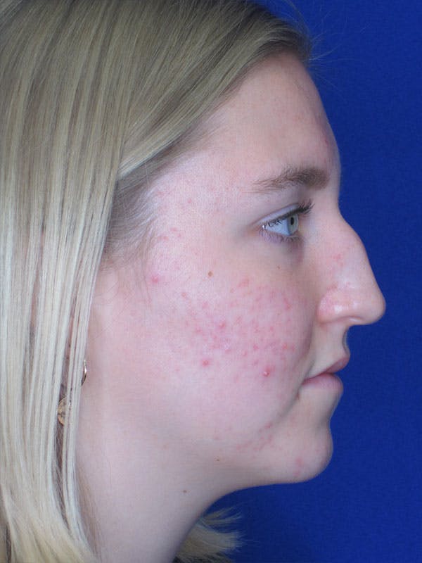 Rhinoplasty Before & After Gallery - Patient 92118134 - Image 3