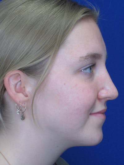 Rhinoplasty Before & After Gallery - Patient 92118134 - Image 4