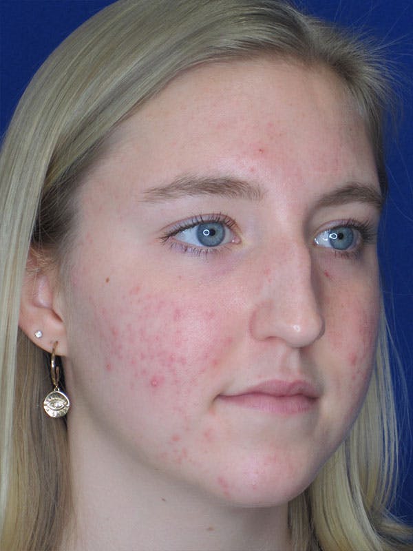 Rhinoplasty Before & After Gallery - Patient 92118134 - Image 5