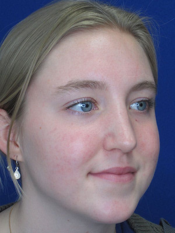 Rhinoplasty Before & After Gallery - Patient 92118134 - Image 6