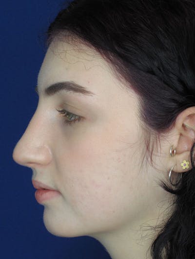 Rhinoplasty Before & After Gallery - Patient 92118195 - Image 4