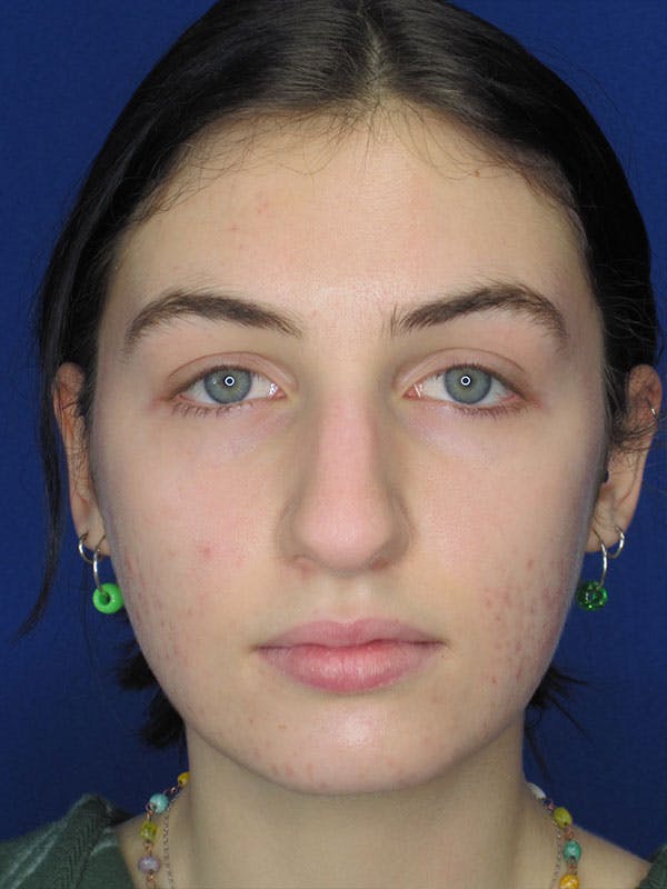 Rhinoplasty Before & After Gallery - Patient 92118195 - Image 5