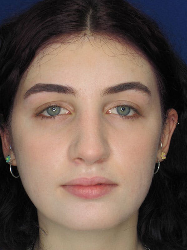 Rhinoplasty Before & After Gallery - Patient 92118195 - Image 6