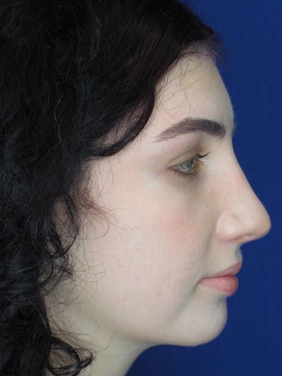 Rhinoplasty Before & After Gallery - Patient 92118195 - Image 8