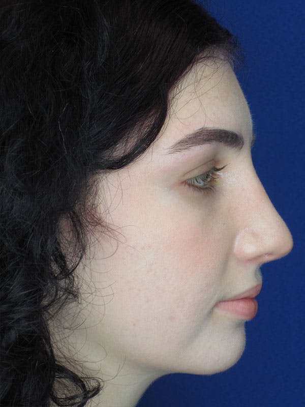 Rhinoplasty Before & After Gallery - Patient 92118195 - Image 8
