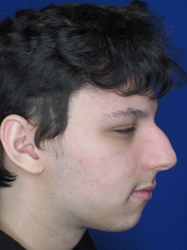 Rhinoplasty Before & After Gallery - Patient 92118196 - Image 1