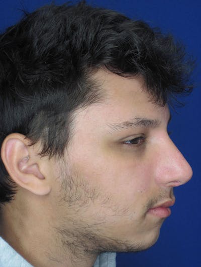 Rhinoplasty Before & After Gallery - Patient 92118196 - Image 2
