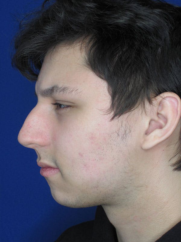Rhinoplasty Before & After Gallery - Patient 92118196 - Image 5