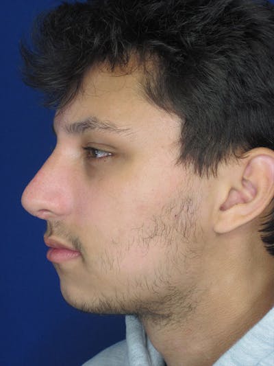 Rhinoplasty Before & After Gallery - Patient 92118196 - Image 6
