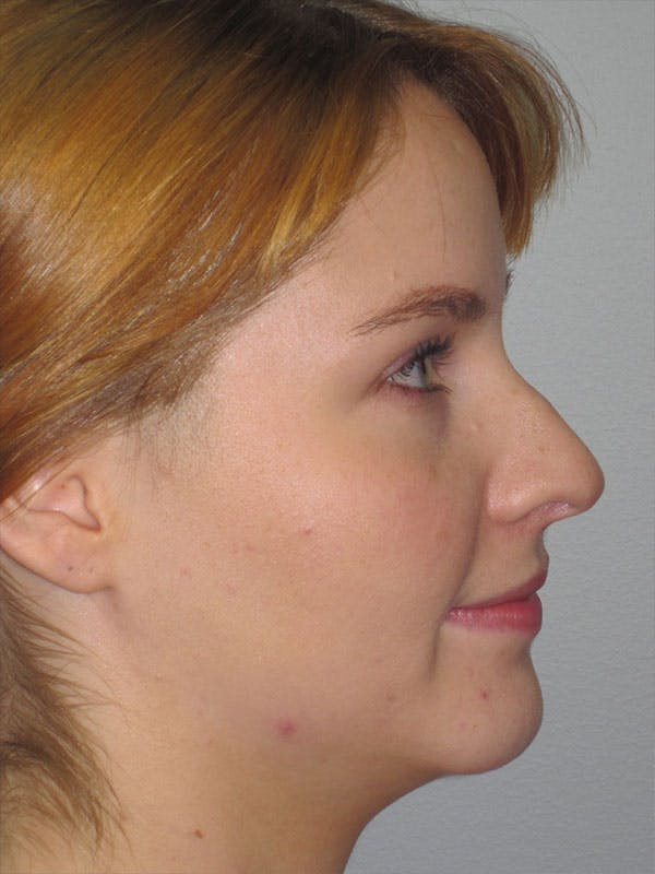 Rhinoplasty Before & After Gallery - Patient 92118197 - Image 1