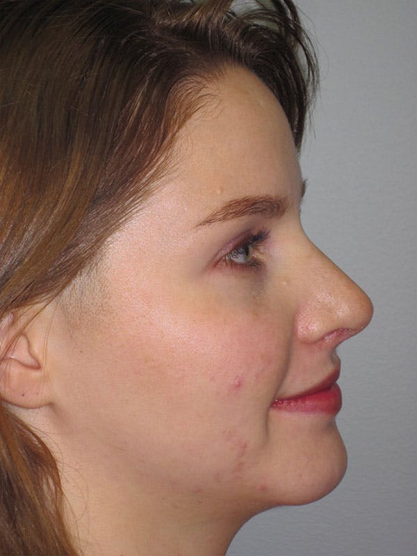 Rhinoplasty Before & After Gallery - Patient 92118197 - Image 2
