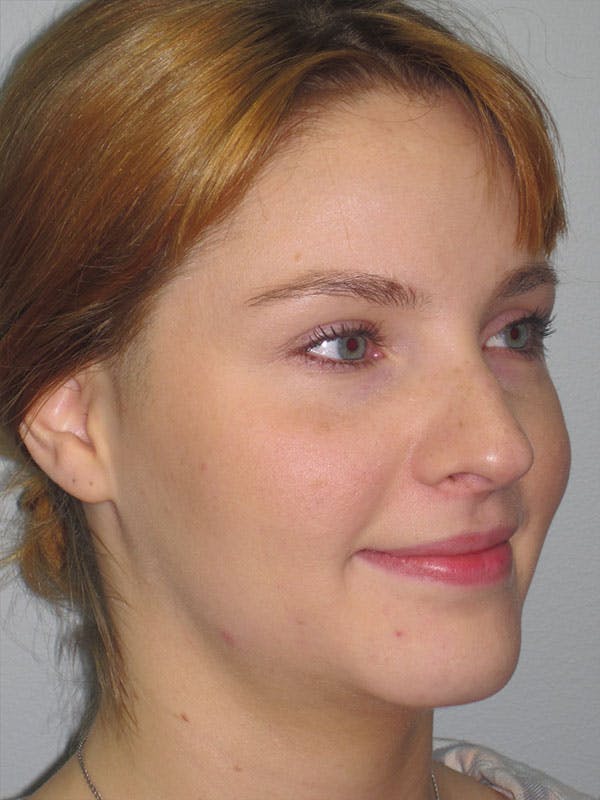 Rhinoplasty Before & After Gallery - Patient 92118197 - Image 3