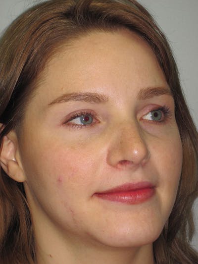 Rhinoplasty Before & After Gallery - Patient 92118197 - Image 4