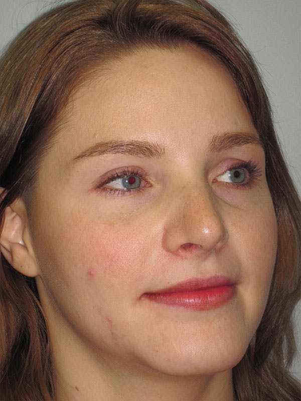 Rhinoplasty Before & After Gallery - Patient 92118197 - Image 4