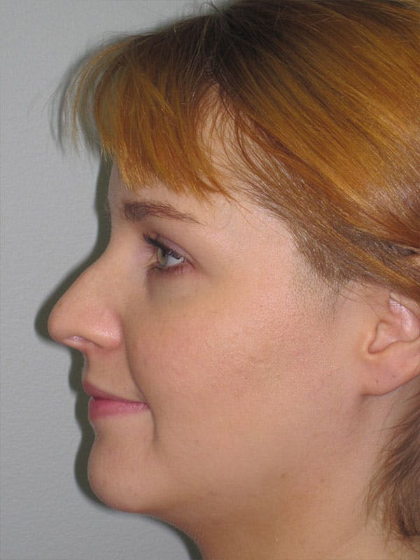 Rhinoplasty Before & After Gallery - Patient 92118197 - Image 5