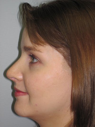 Rhinoplasty Before & After Gallery - Patient 92118197 - Image 6