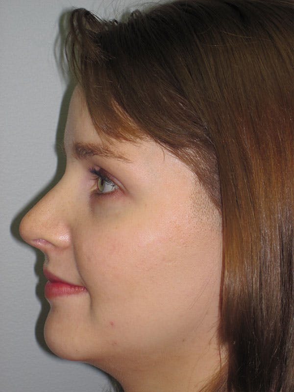 Rhinoplasty Before & After Gallery - Patient 92118197 - Image 6