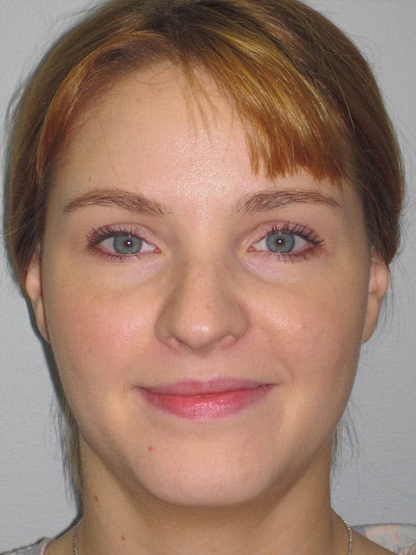 Rhinoplasty Before & After Gallery - Patient 92118197 - Image 7