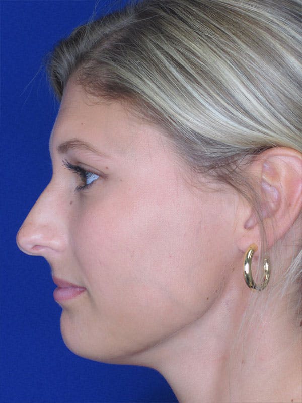 Rhinoplasty Before & After Gallery - Patient 92118210 - Image 3