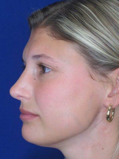 Rhinoplasty Before & After Gallery - Patient 92118210 - Image 4