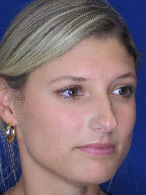Rhinoplasty Before & After Gallery - Patient 92118210 - Image 5