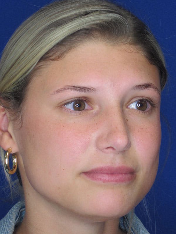 Rhinoplasty Before & After Gallery - Patient 92118210 - Image 6