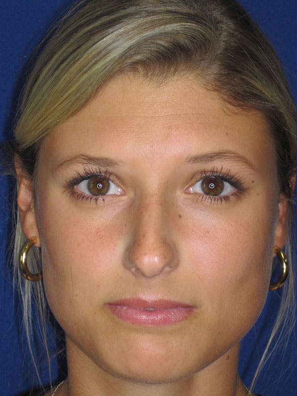 Rhinoplasty Before & After Gallery - Patient 92118210 - Image 1