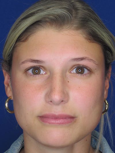 Rhinoplasty Before & After Gallery - Patient 92118210 - Image 2