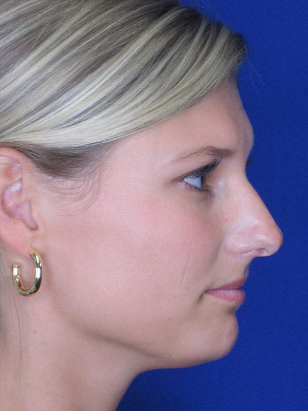 Rhinoplasty Before & After Gallery - Patient 92118210 - Image 7