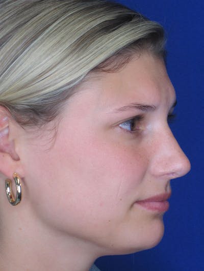 Rhinoplasty Before & After Gallery - Patient 92118210 - Image 8