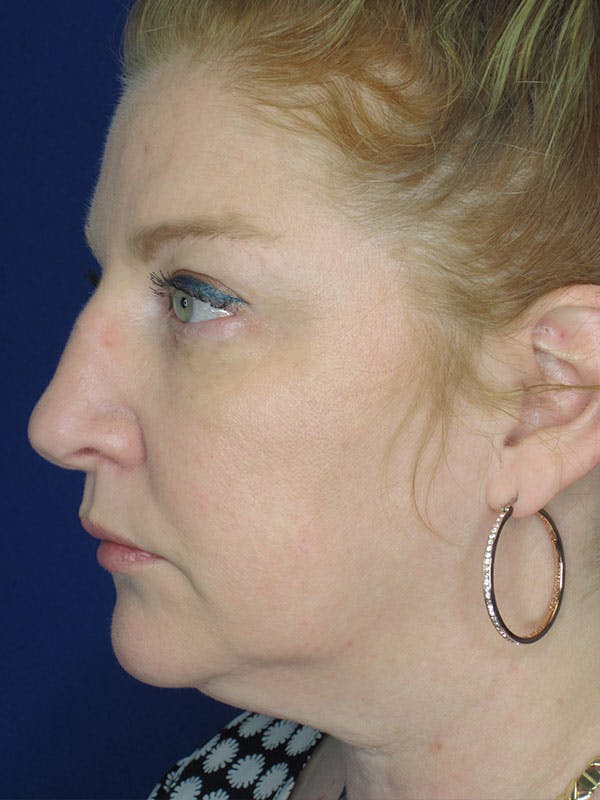 Rhinoplasty Before & After Gallery - Patient 92118224 - Image 1