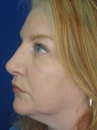 Rhinoplasty Before & After Gallery - Patient 92118224 - Image 2