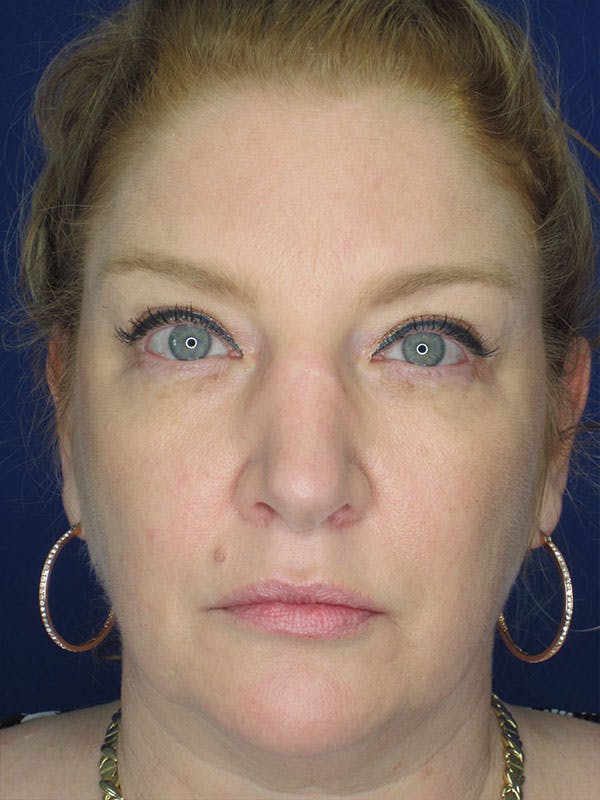 Rhinoplasty Before & After Gallery - Patient 92118224 - Image 3
