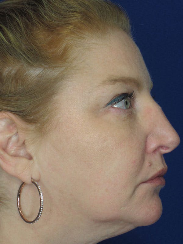 Rhinoplasty Before & After Gallery - Patient 92118224 - Image 7