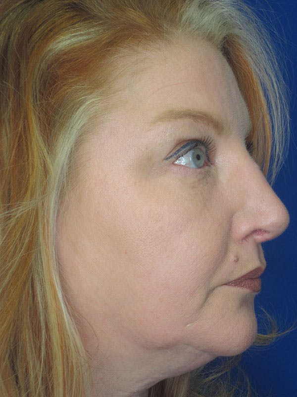 Rhinoplasty Before & After Gallery - Patient 92118224 - Image 8