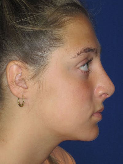 Rhinoplasty Before & After Gallery - Patient 92118228 - Image 2