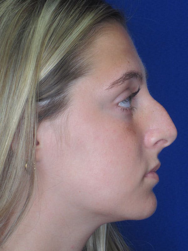 Rhinoplasty Before & After Gallery - Patient 92118228 - Image 1