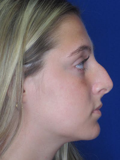 Rhinoplasty Before & After Gallery - Patient 92118228 - Image 1