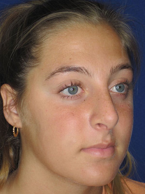 Rhinoplasty Before & After Gallery - Patient 92118228 - Image 4